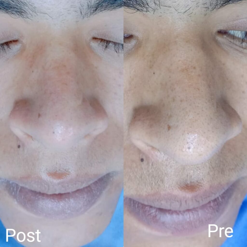 Blackhead removal for men in Hurghada